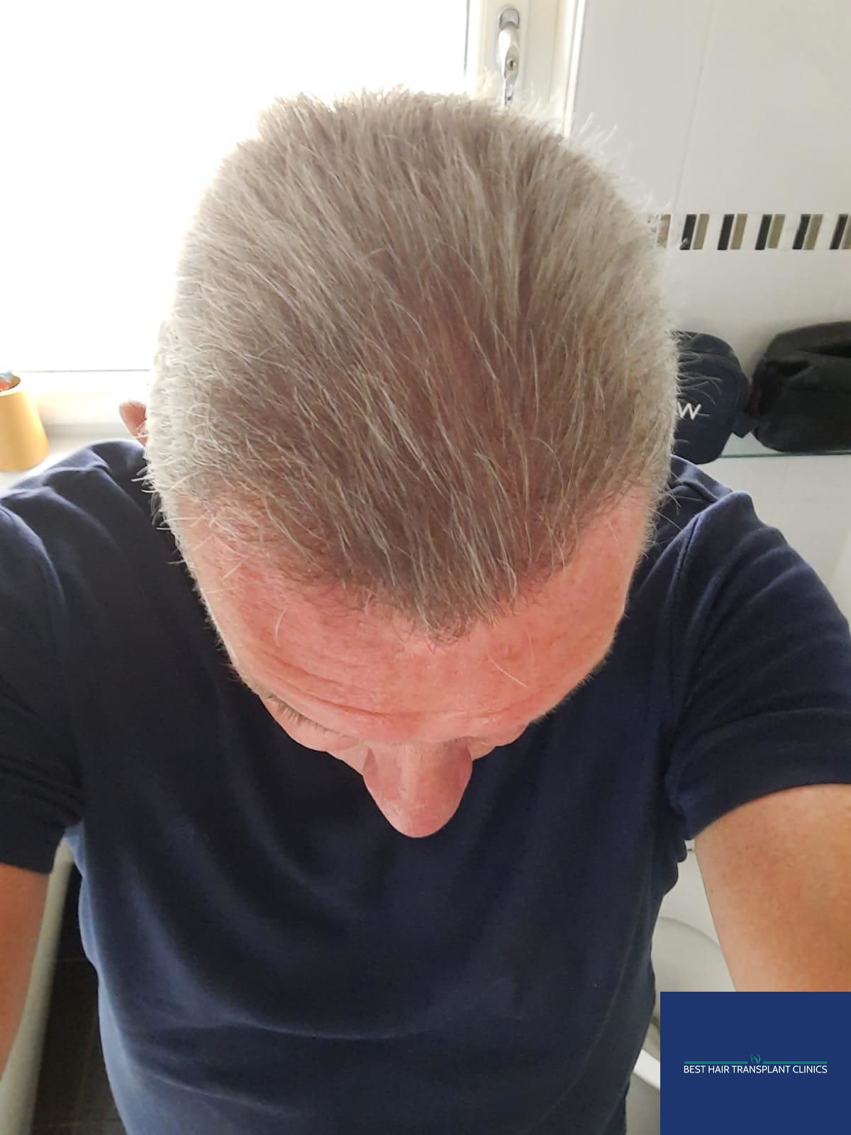 a picture of a male patient after an fue hair transplant with Best Hair Transplant Clinic Liverpool