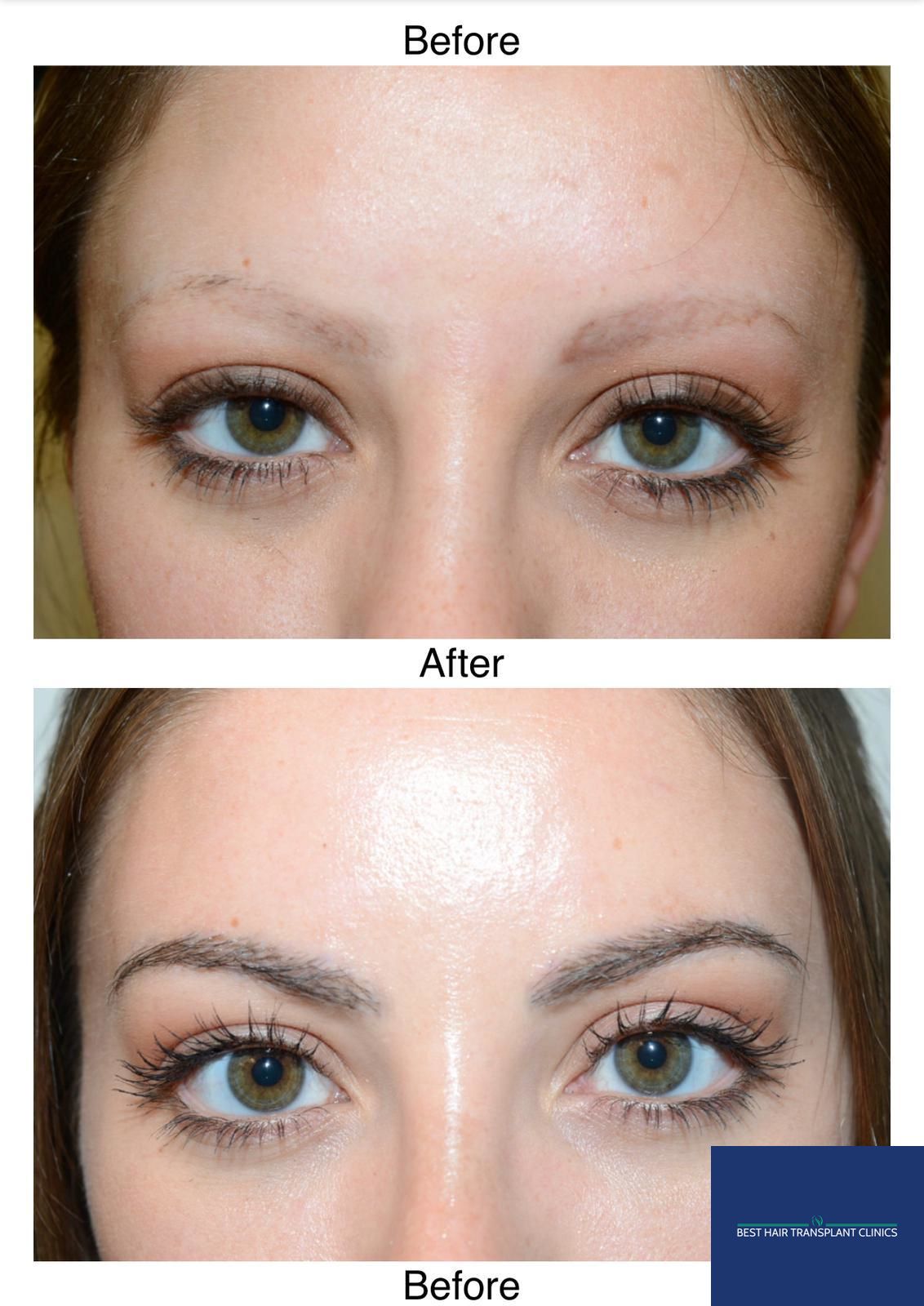 a picture of a female patient before and after an fue eyebrow hair transplant with Best Hair Transplant Clinic Liverpool
