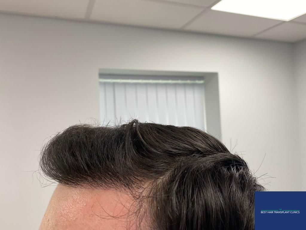 a picture of a male patient after an fue hair transplant with Best Hair Transplant Clinic Liverpool