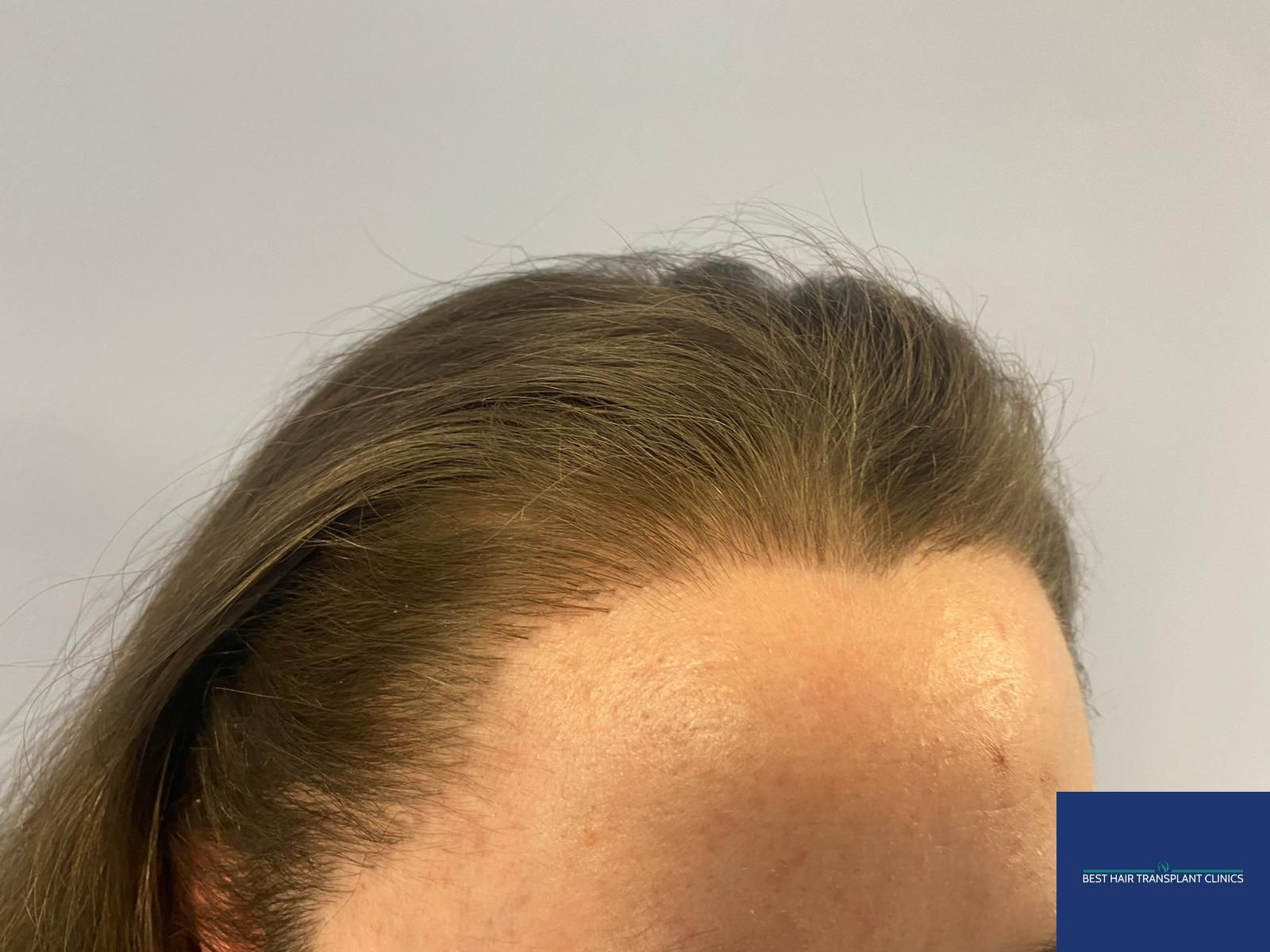 a picture of a female patient after an fue hair transplant with Best Hair Transplant Clinic Liverpool