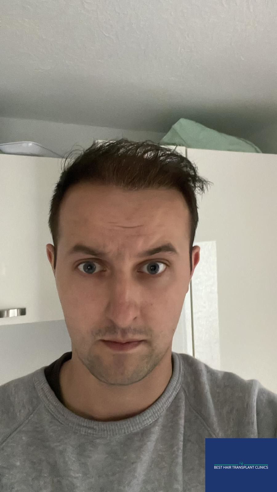 a picture of a male patient after an fue hair transplant with Best Hair Transplant Clinic Liverpool