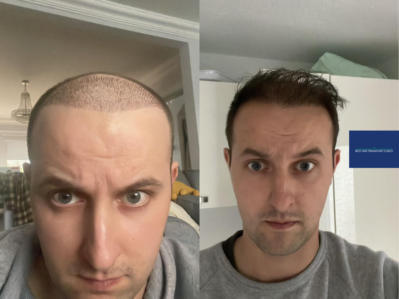 a picture of a male patient before and after an fue hair transplant with Best Hair Transplant Clinic Liverpool