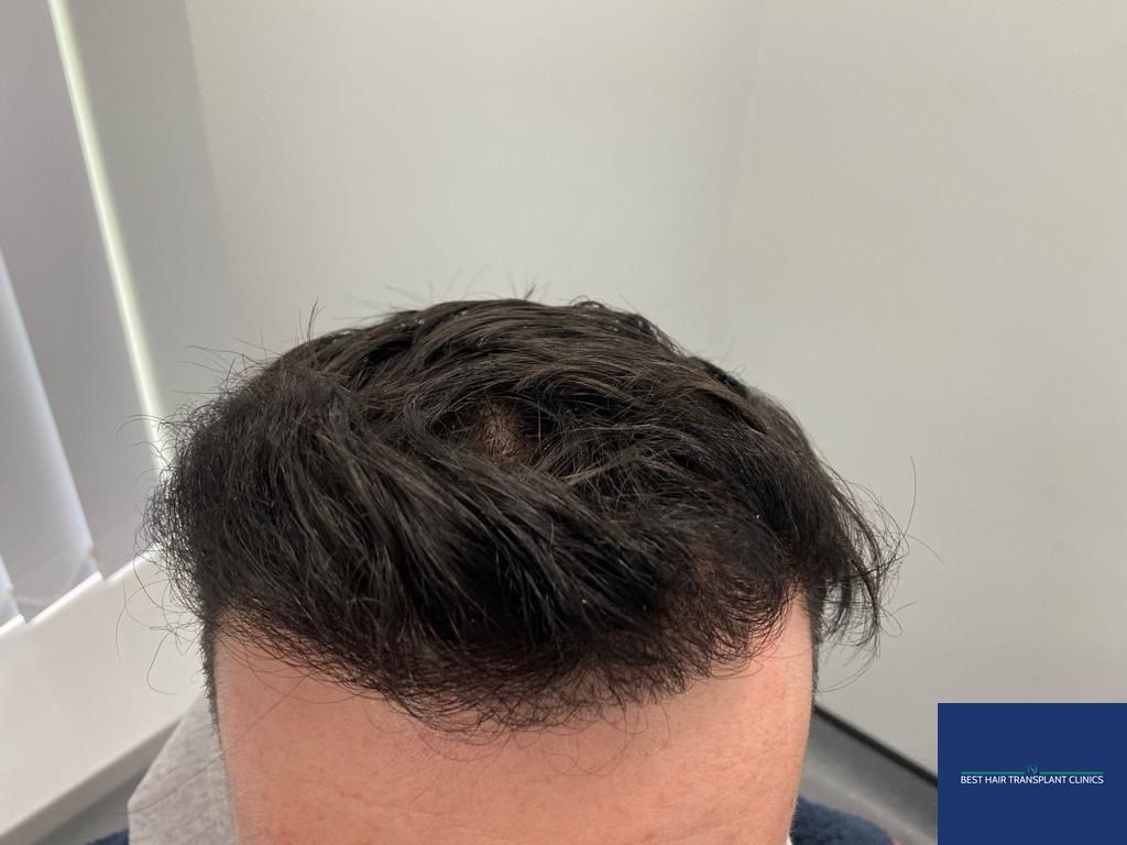 a picture of a male patient after an fue hair transplant with Best Hair Transplant Clinic Liverpool