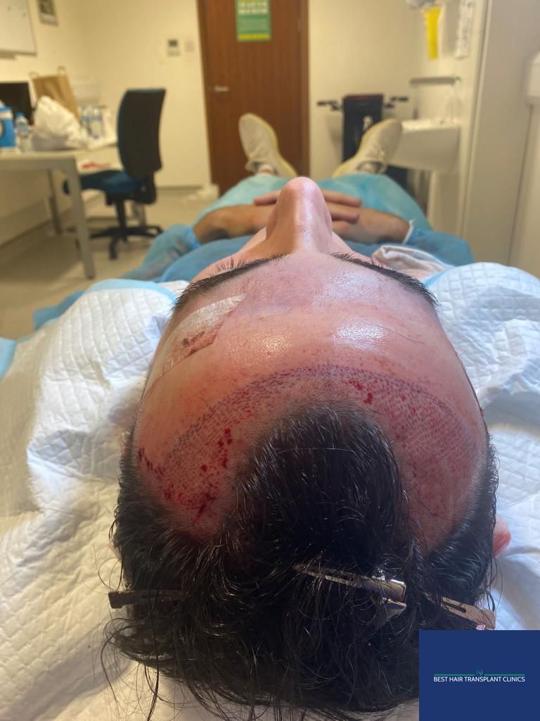 a picture of a male patient during an fue hair transplant with Best Hair Transplant Clinic Liverpool