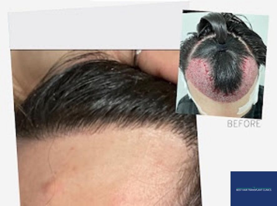 a picture of a male patient before and after an fue hair transplant with Best Hair Transplant Clinic Liverpool