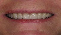 Veneers Gallery 4