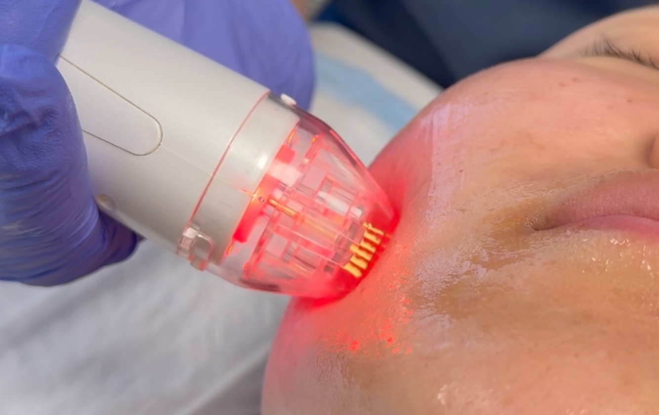 A person receiving a facial treatment. A technician uses a red-lit device on the cheek.