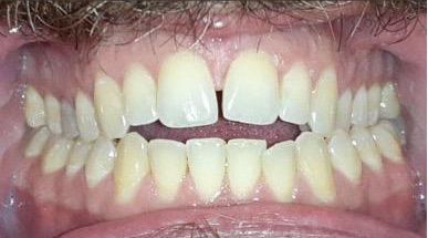 A close up of a man 's teeth with a beard.
