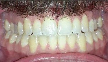 A close up of a man 's teeth with a mustache.