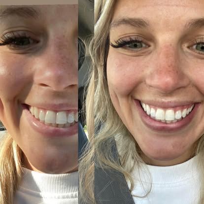 A woman 's teeth before and after whitening.