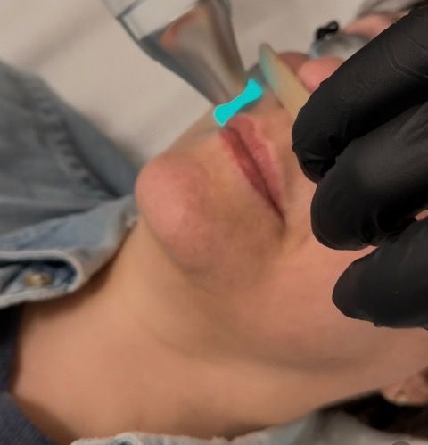 A woman is getting a laser treatment on her face.