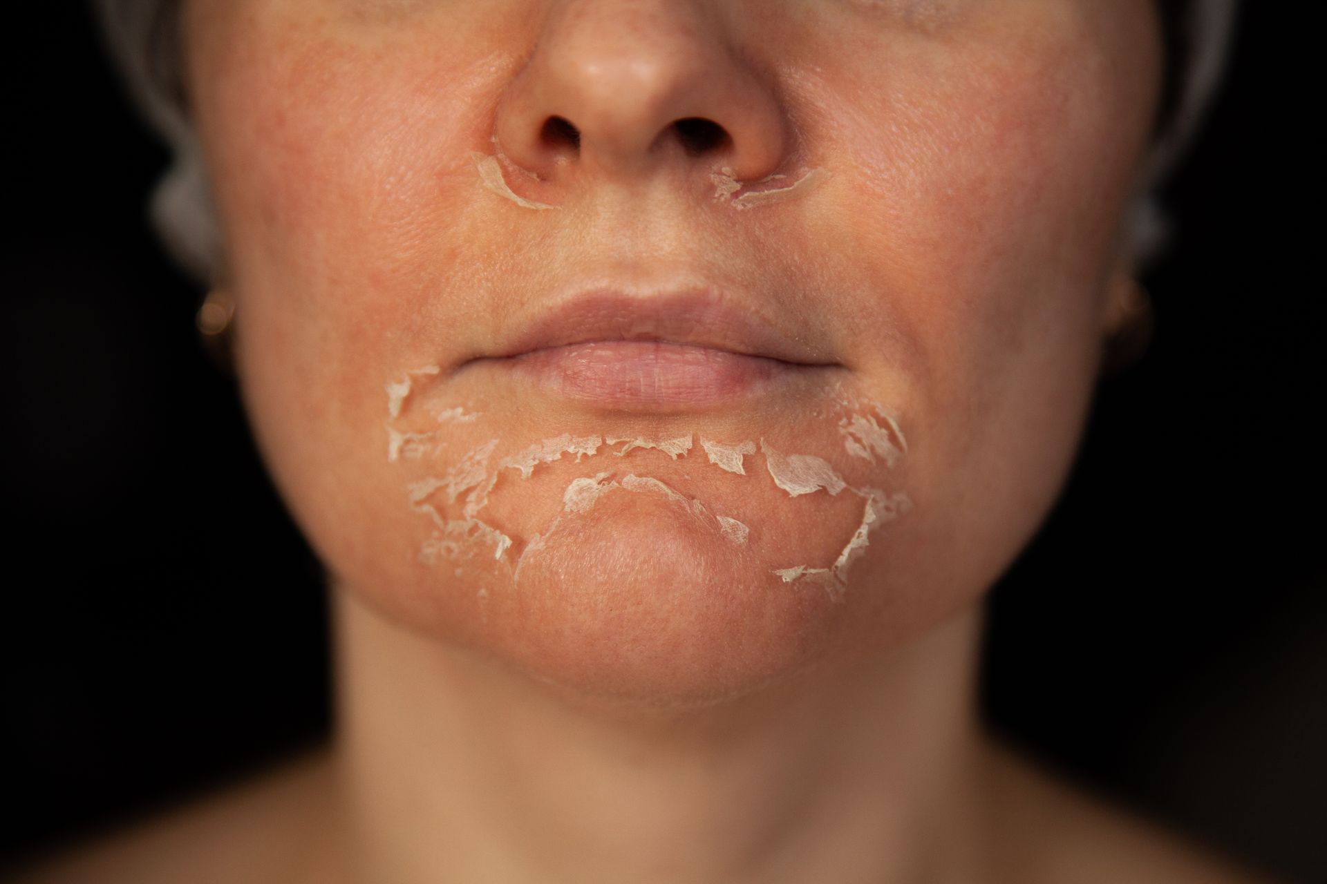 A close up of a woman 's face with peeling skin.