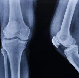 X-ray-of-leg-knee