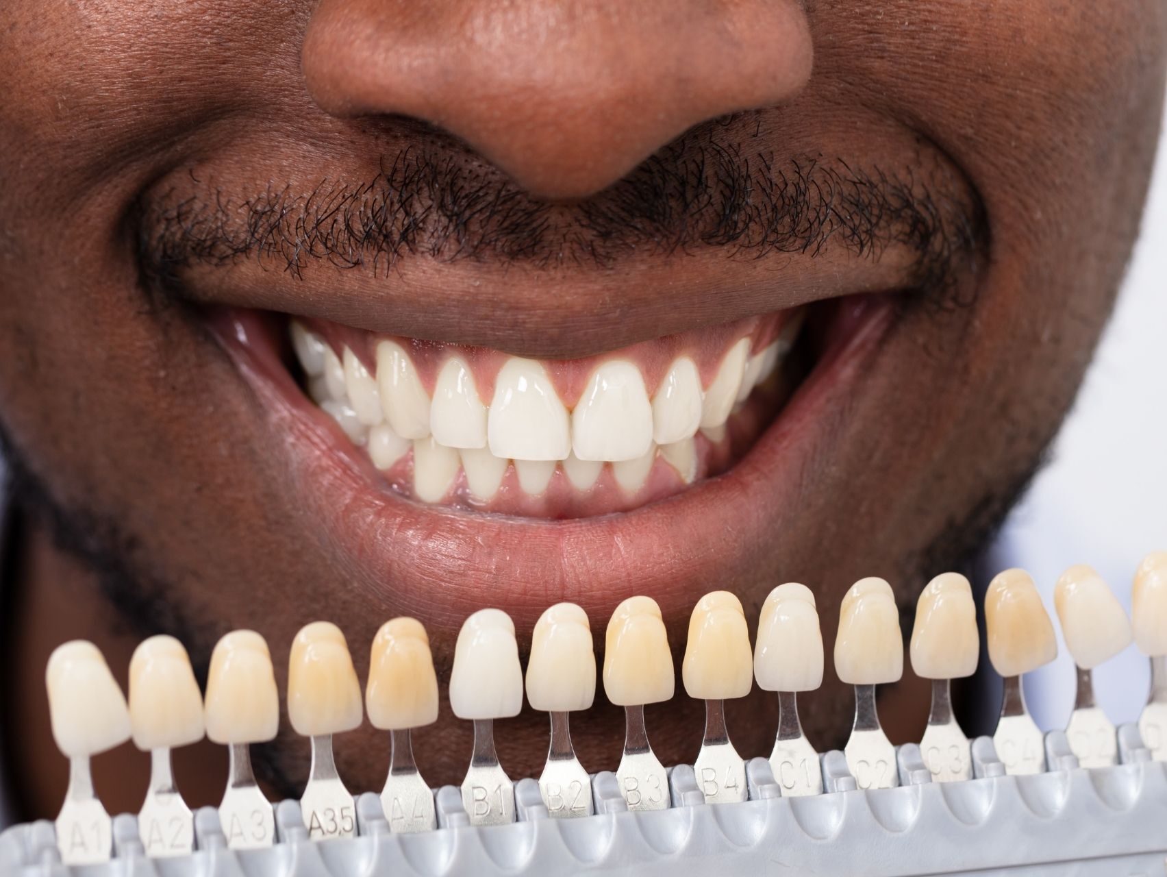 Dental Veneers Near McLoud