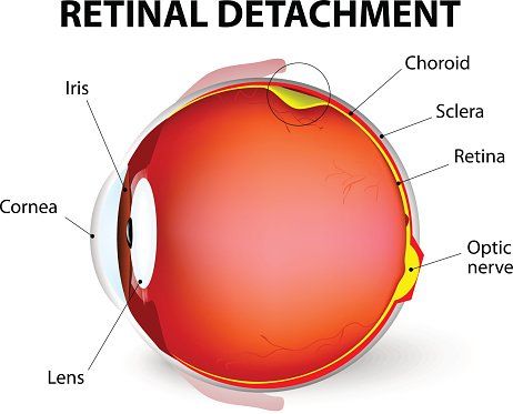 Retinal detachment diagram - Retinal detachment surgery in Clearwater, FL