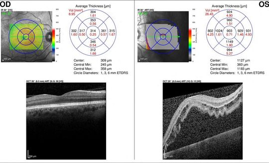 Retina detachment diagram - Retinal detachment causes and symptoms in Bayonet Point, FL