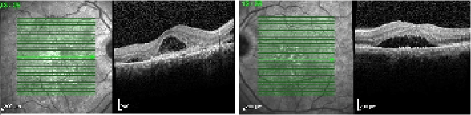 macular - Eye Care in Clearwater, FL