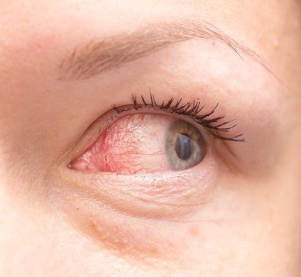 Irritated eye - Uveitis in Clearwater, FL