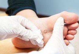 Wart On Foot — Dermatology in Howard Beach NY