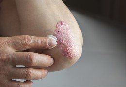 Psoriasis On Elbow — Dermatology in Howard Beach NY