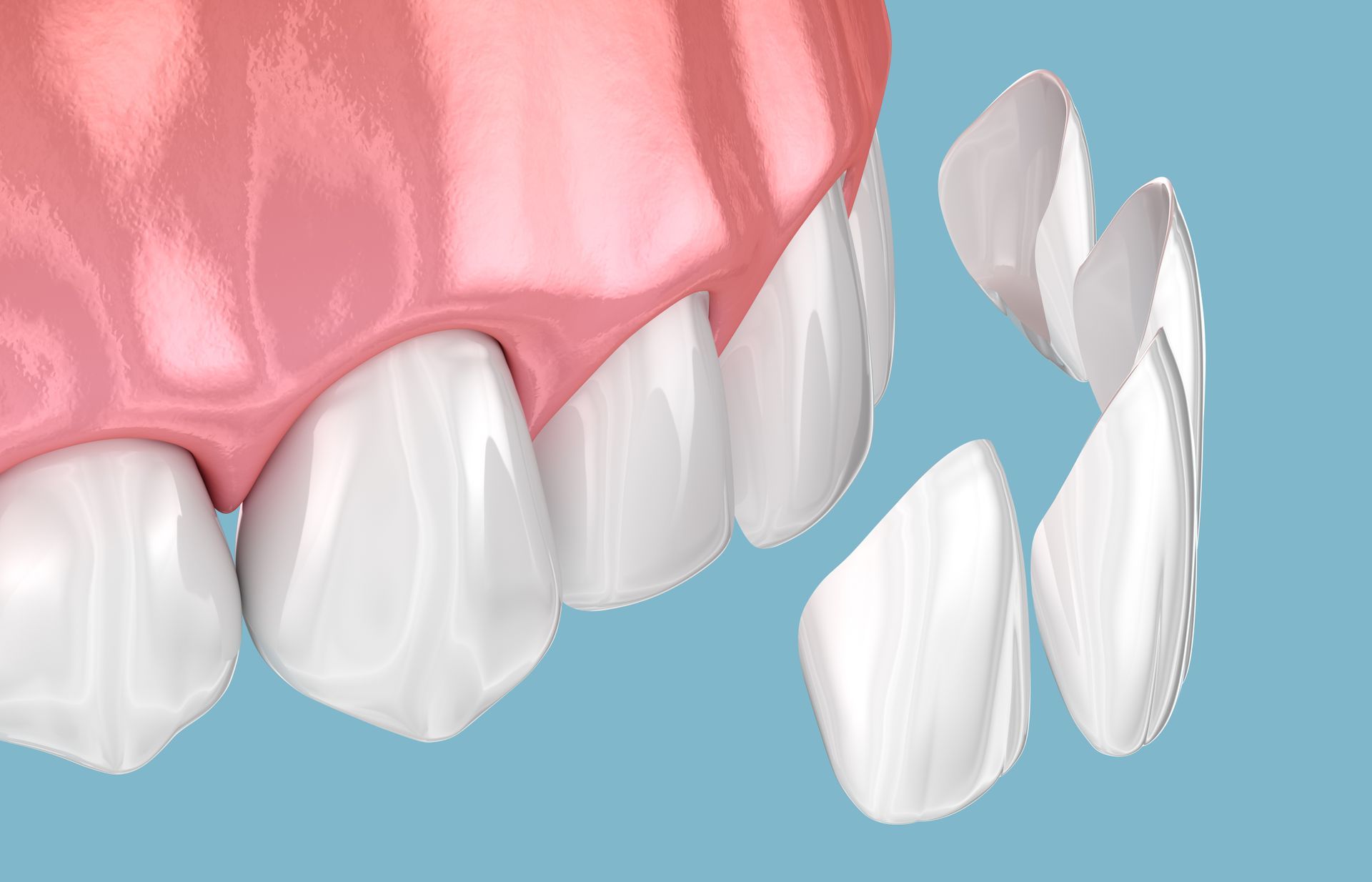 A close up of a person 's teeth with dental porcelain veneers.