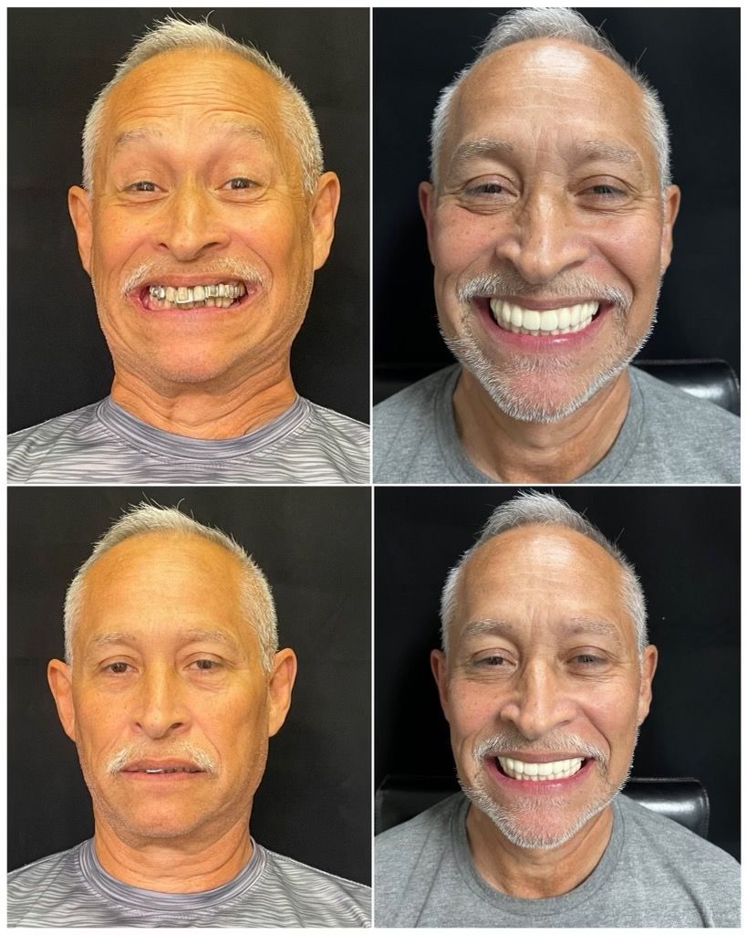 dental implants before and afters