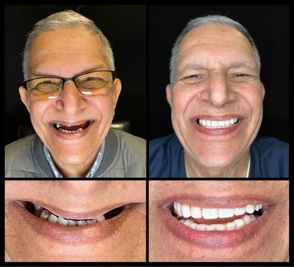 dental implants before and afters