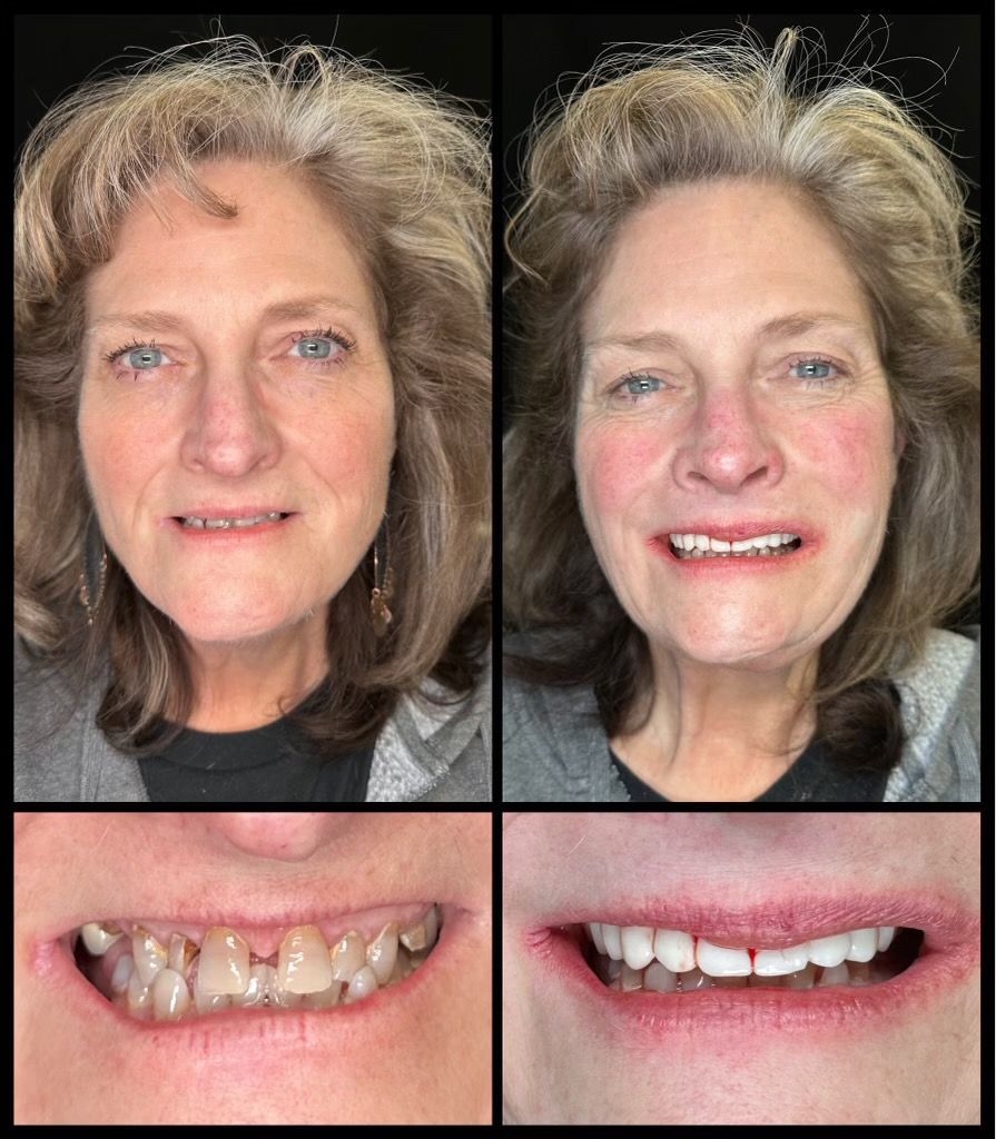 dental implants before and afters