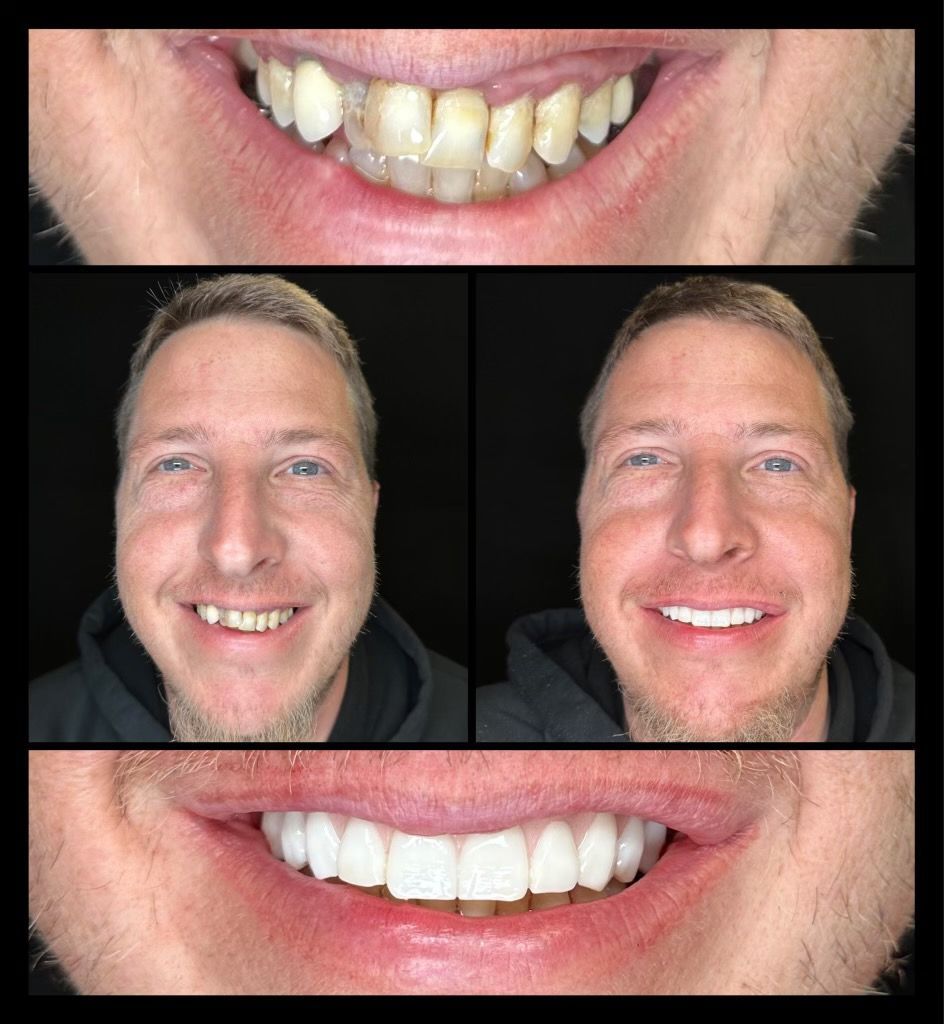 dental implants before and afters