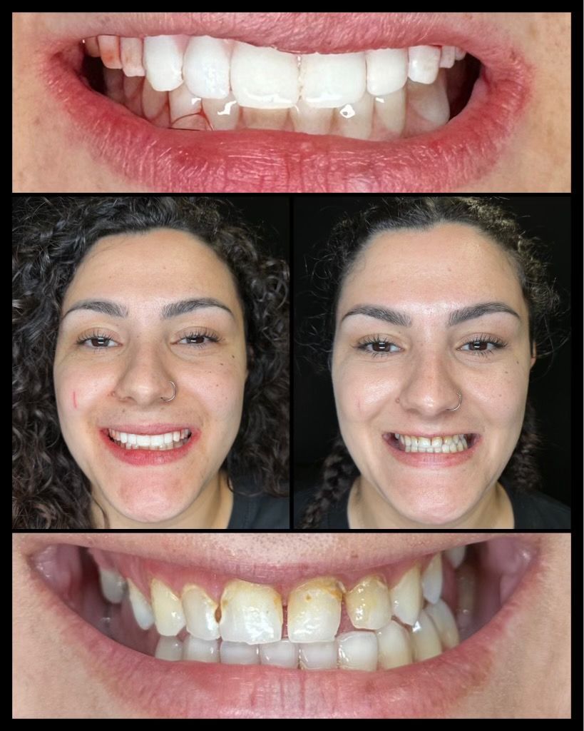 dental implants before and afters