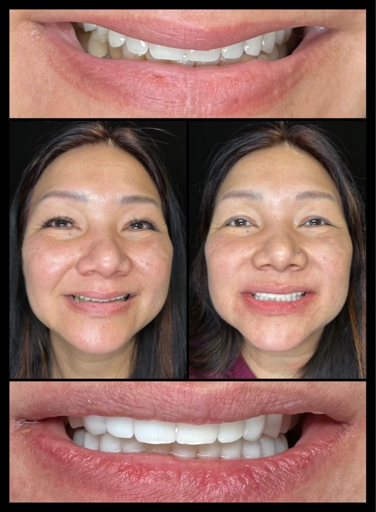 dental implants before and afters