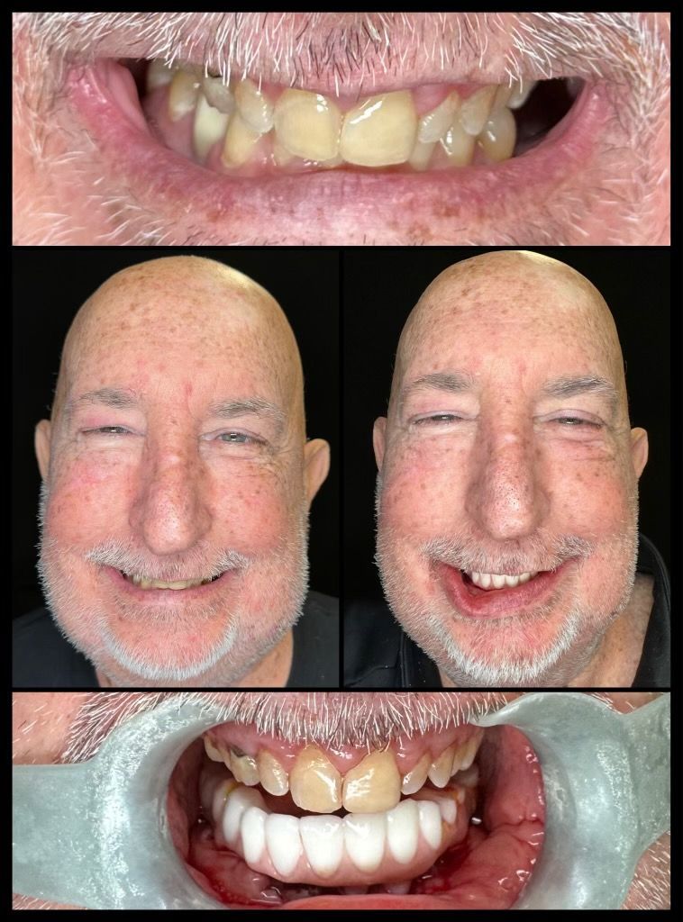 dental implants before and afters