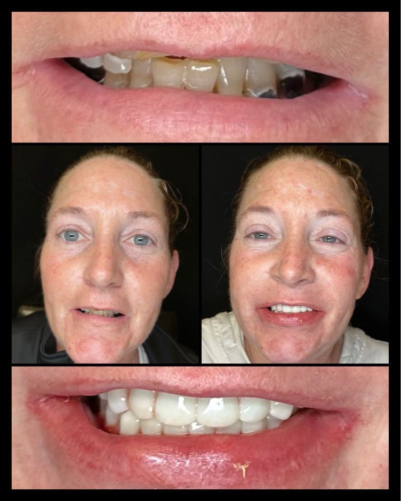dental implants before and afters