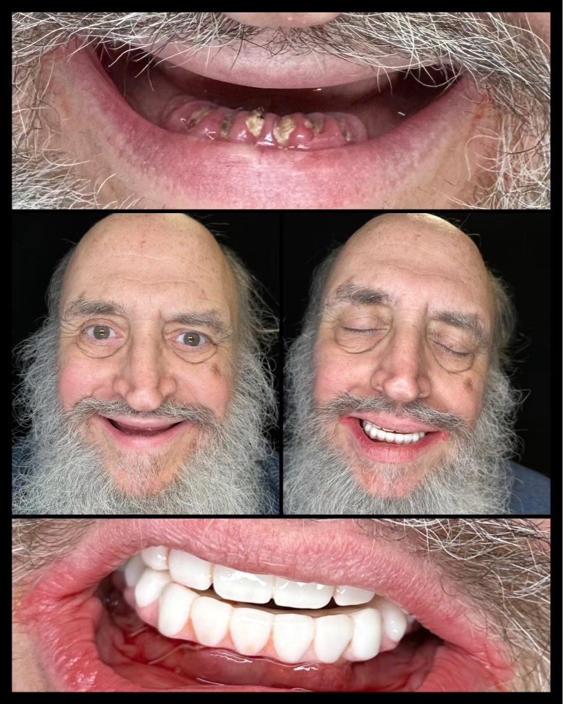 dental implants before and afters