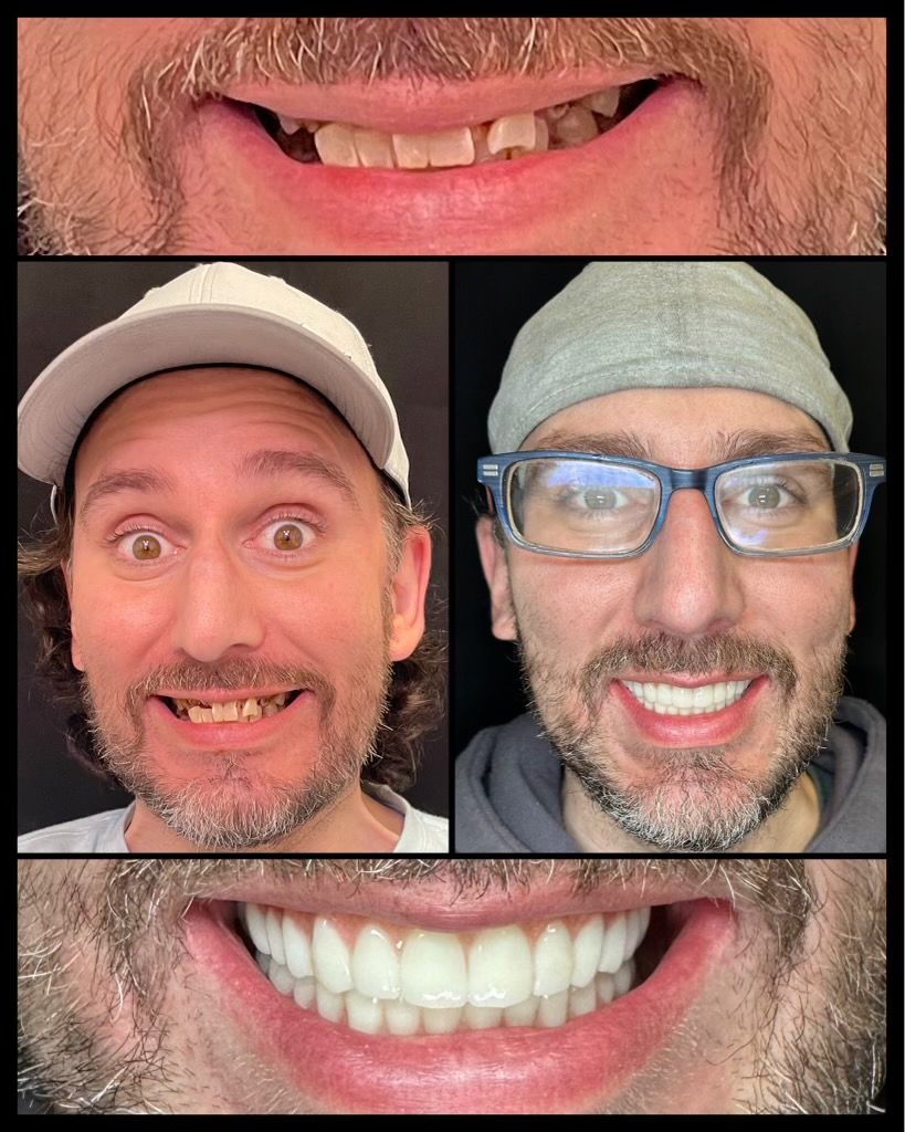 dental implants before and afters