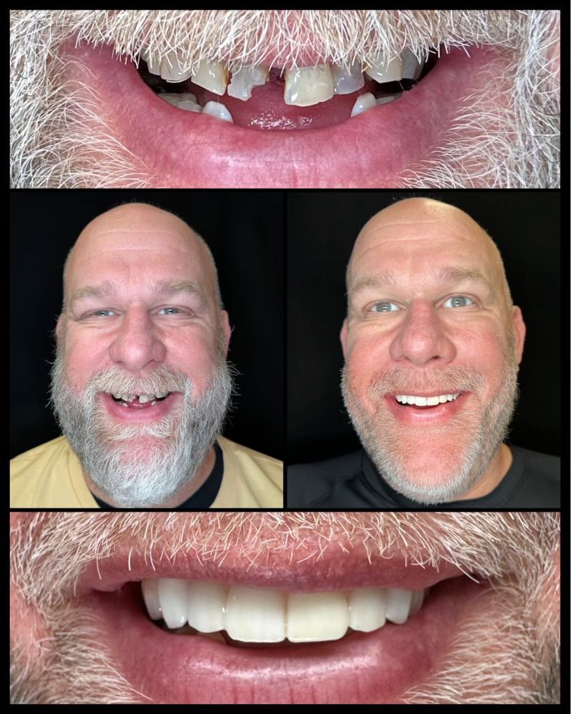 dental implants before and afters