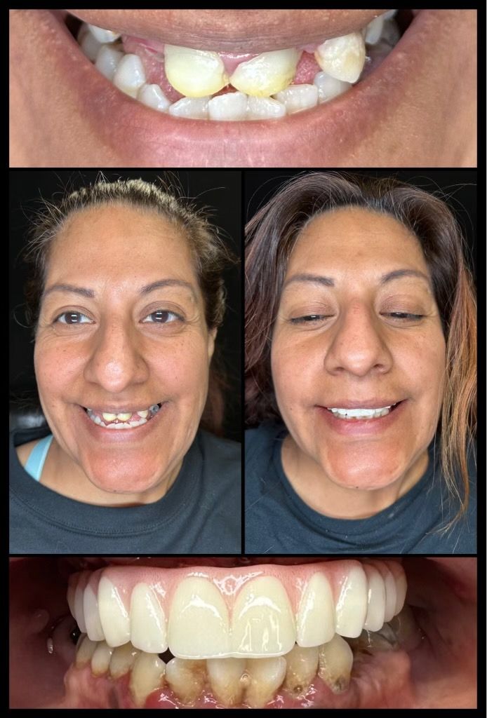 dental implants before and afters