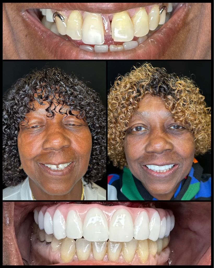 dental implants before and afters