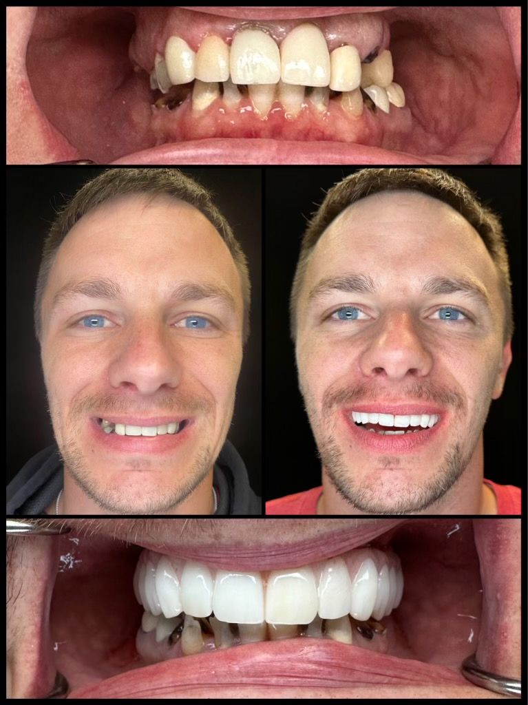 dental implants before and afters