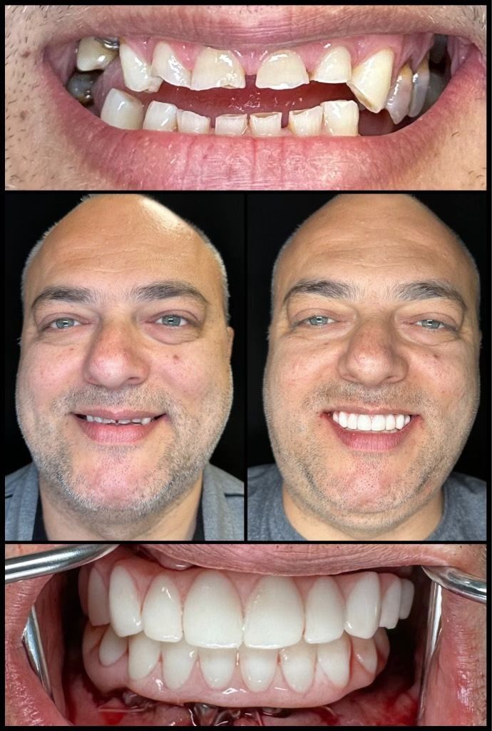 dental implants before and afters