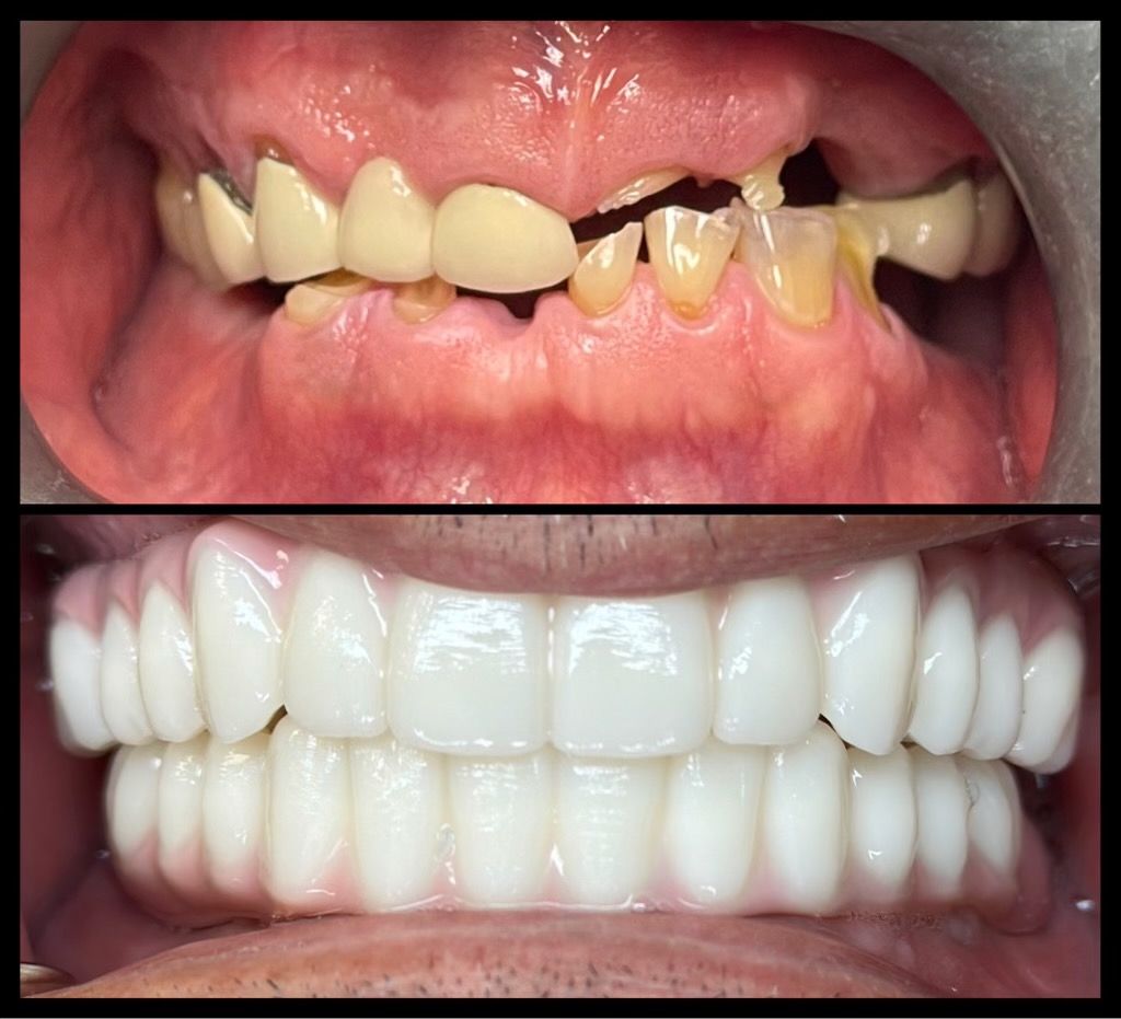 dental implants before and afters