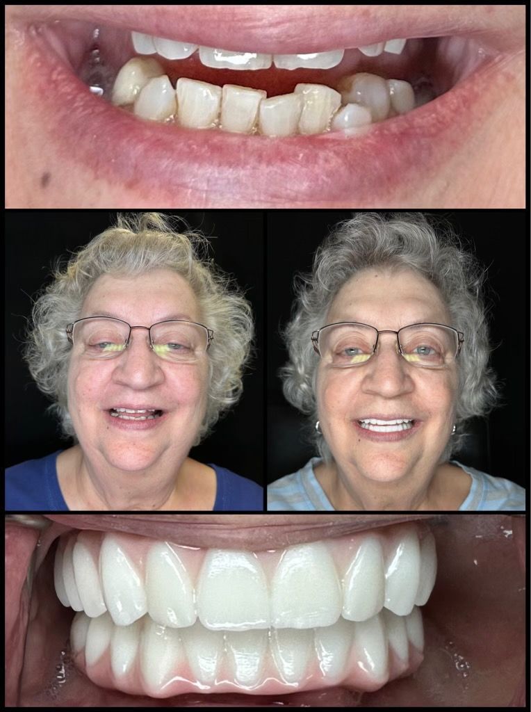 dental implants before and afters