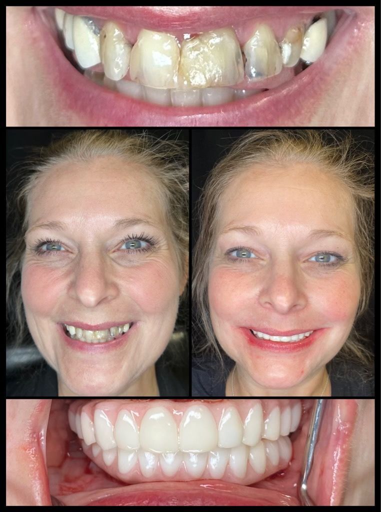 dental implants before and afters