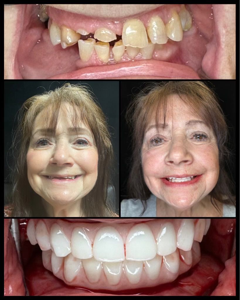 dental implants before and afters