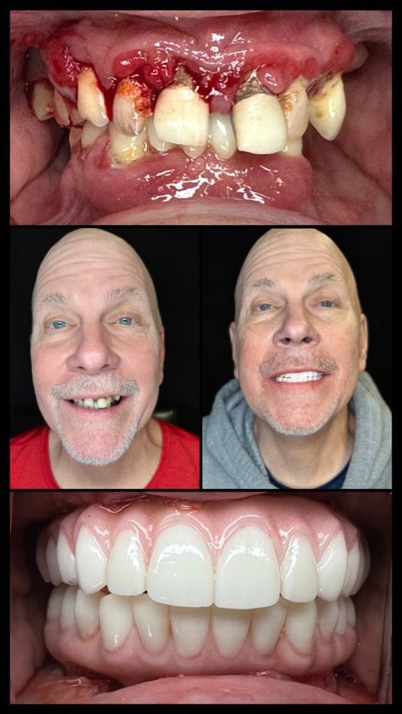 dental implants before and afters
