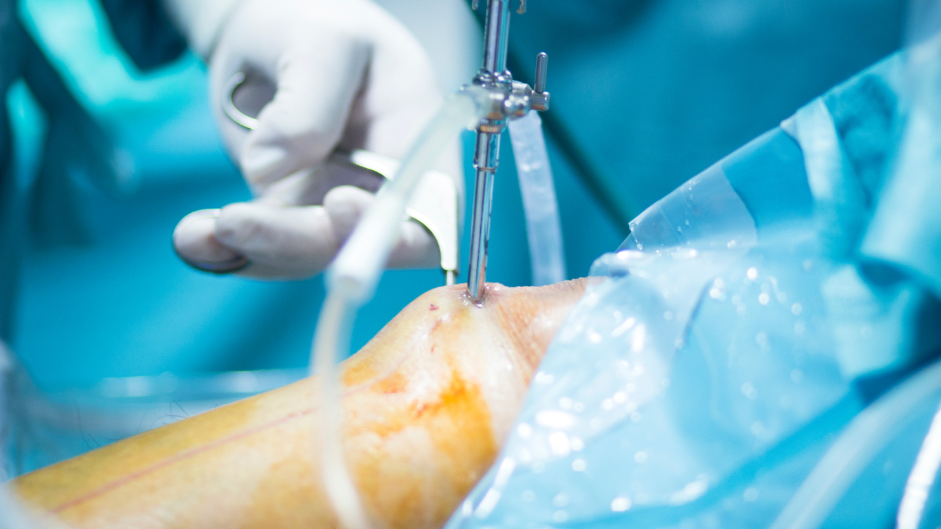 arthroscopic surgery