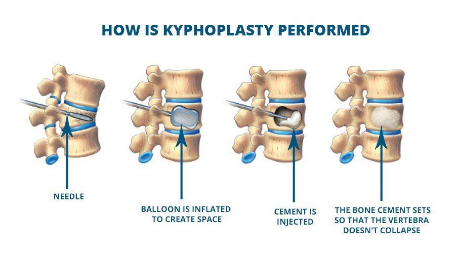 kyphoplasty infographic