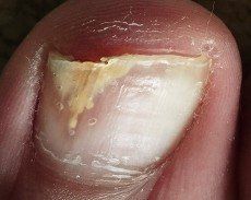 damaged nail