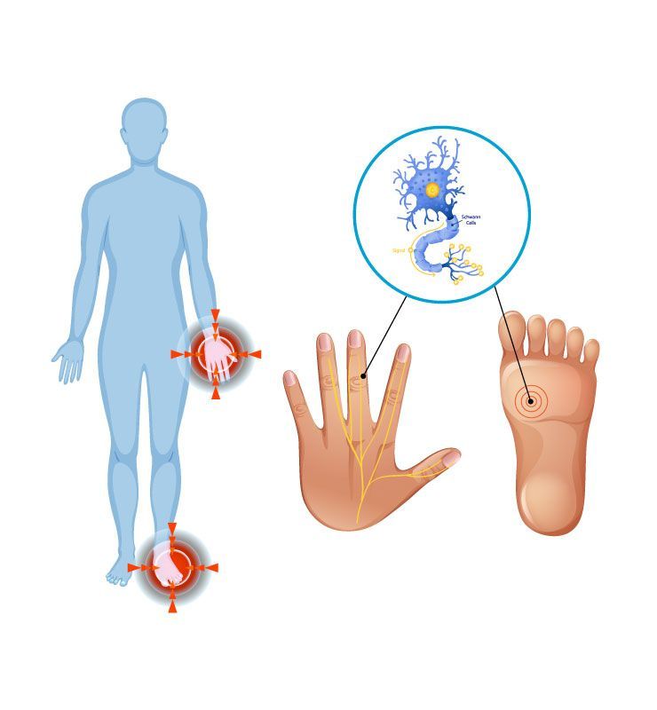 graphic showing peripheral neuropathic pain points in the feet and hands