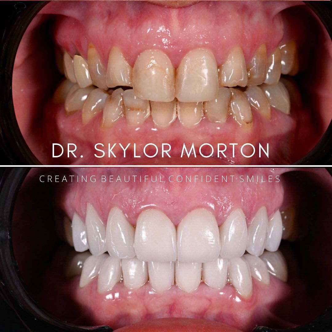 teeth before and after dental treatment